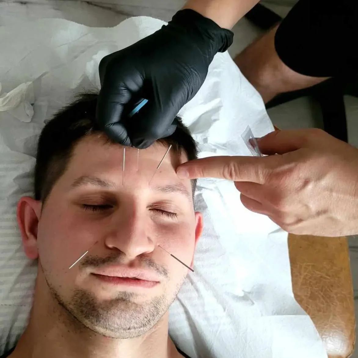 akupunktura akupunktura