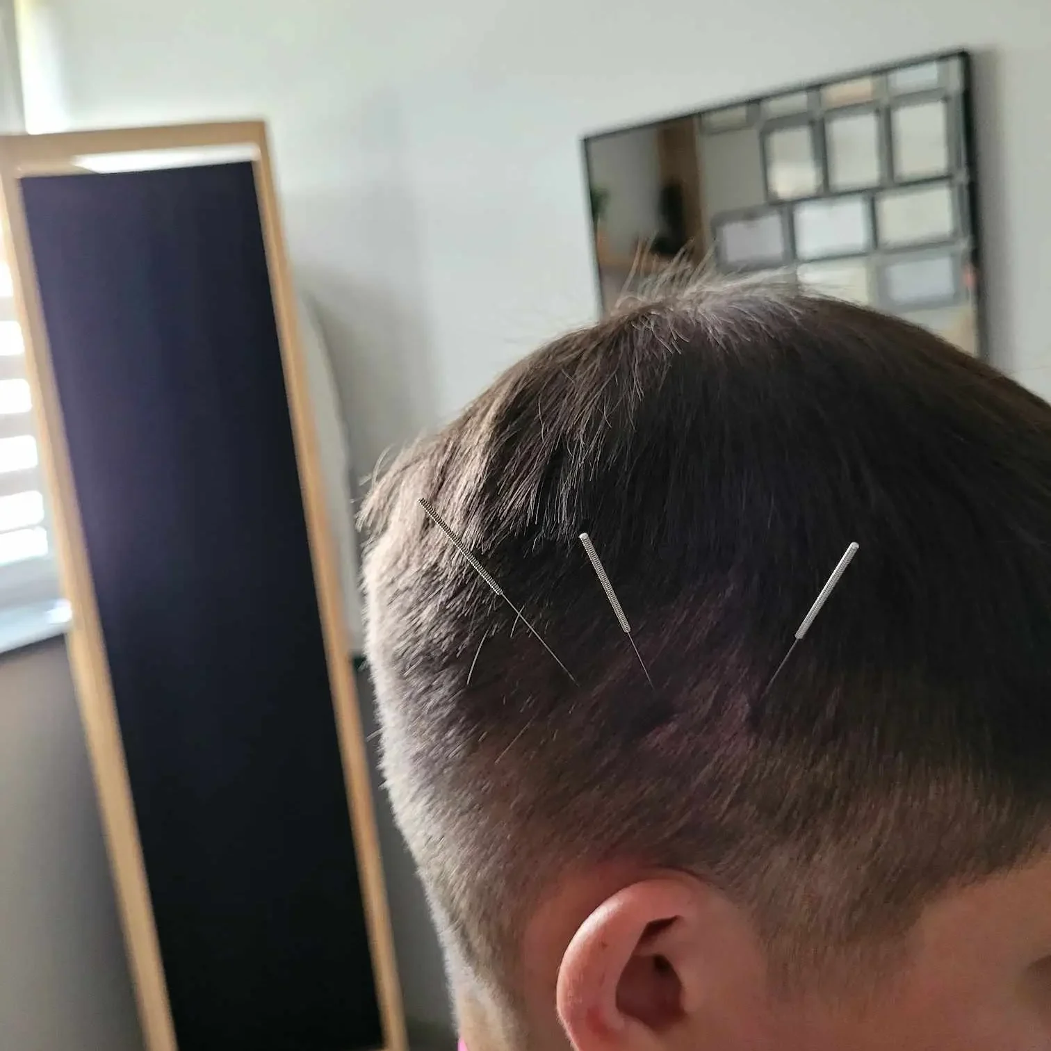 akupunktura_czaszki akupunktura_czaszki