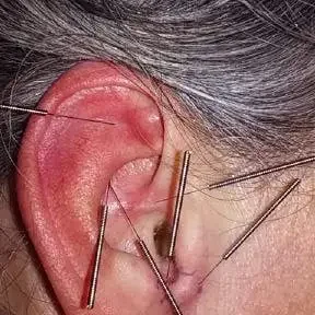 aurikuloterapia aurikuloterapia