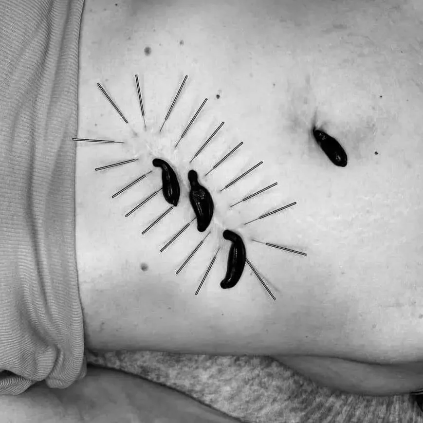 terapia_blizn_pooperacyjnych terapia_blizn_pooperacyjnych