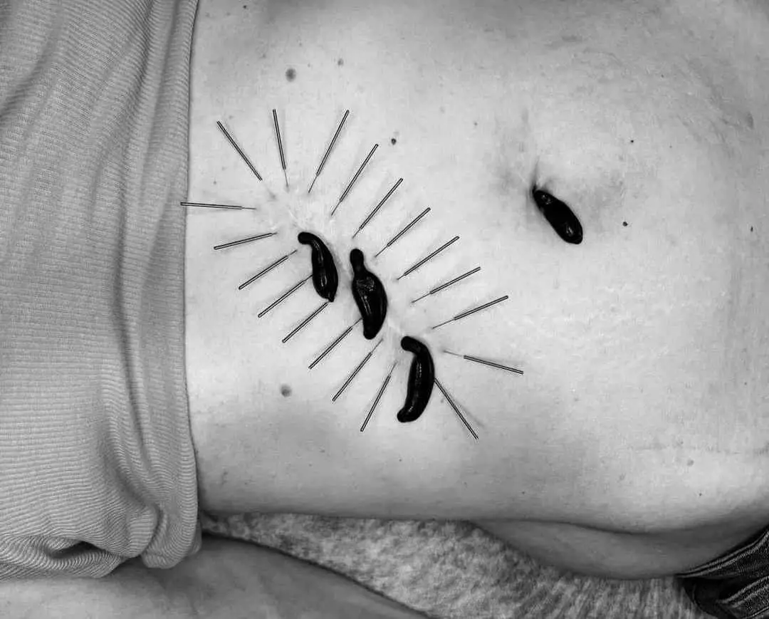 Terapia blizn pooperacyjnych